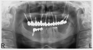 fog implantátum